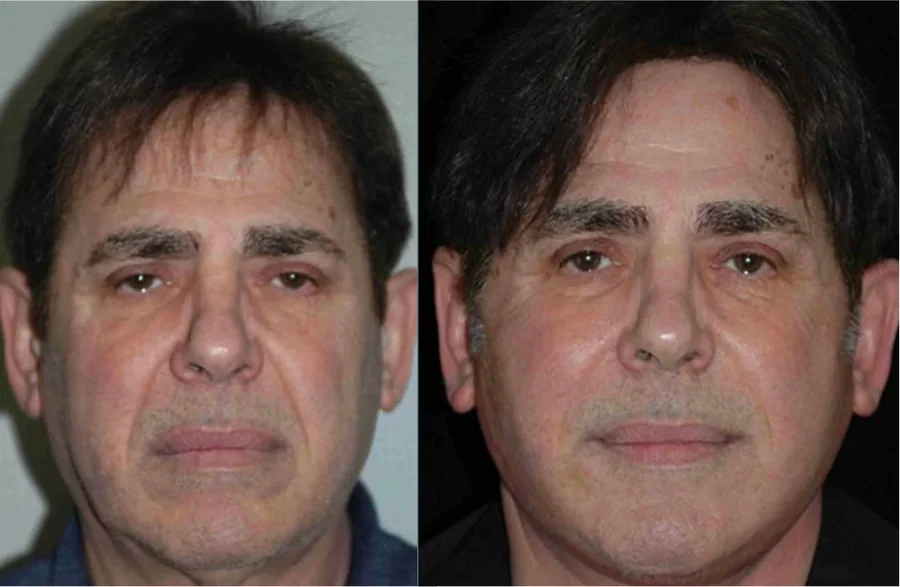 Facelift before and after