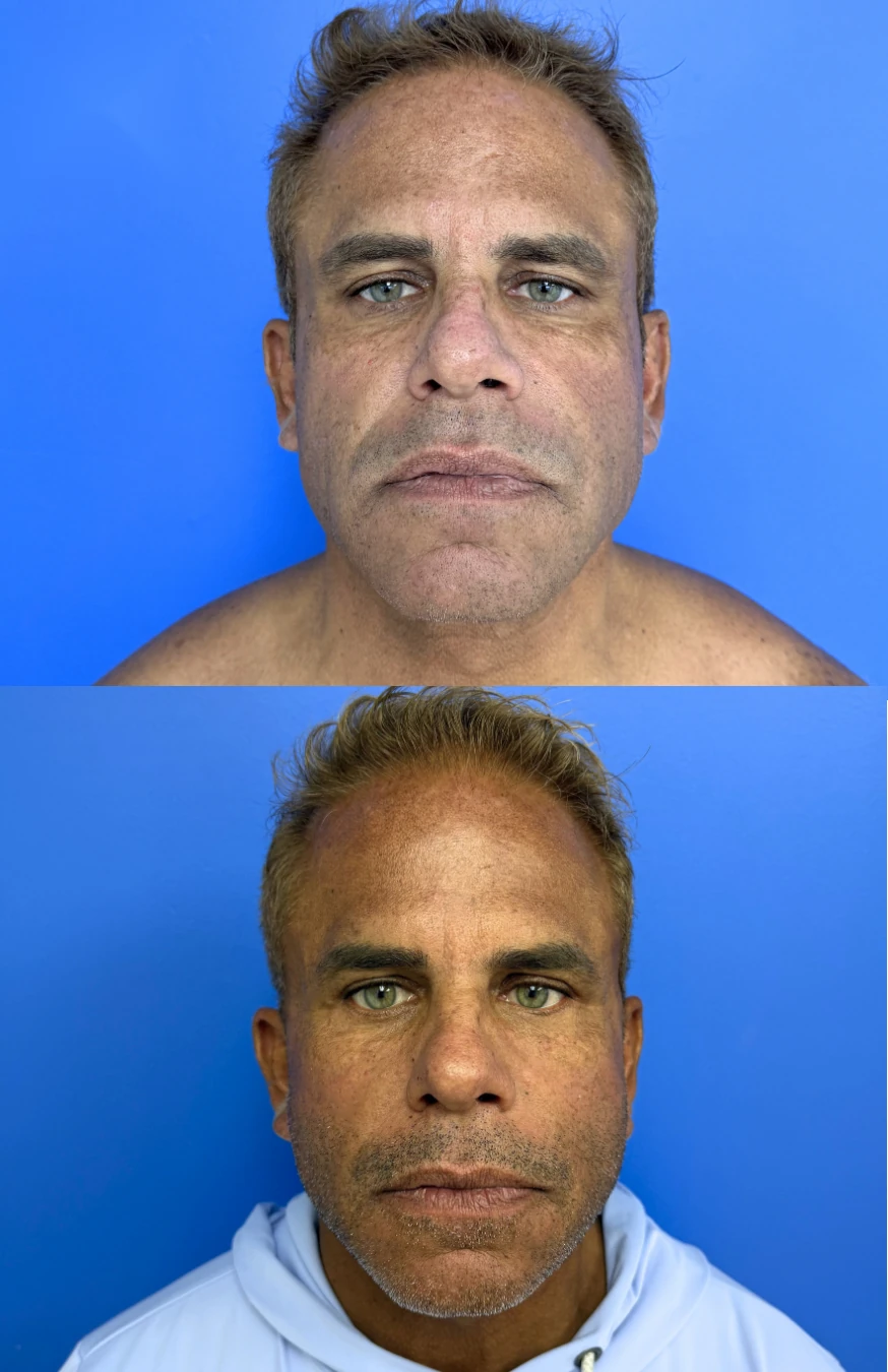 Facelift before and after