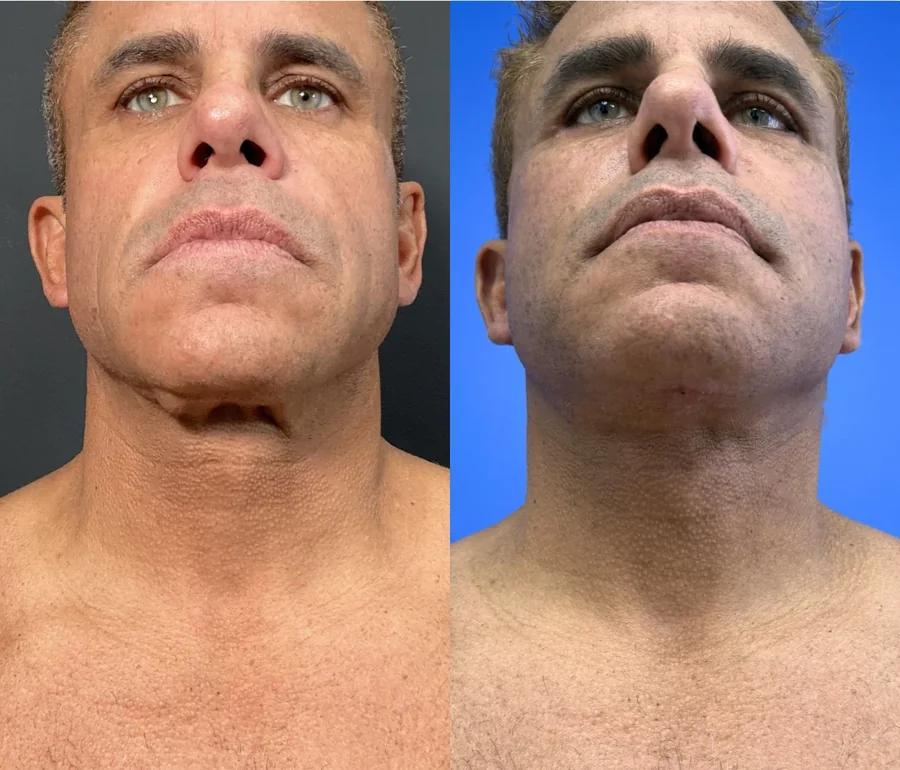 Facelift before and after