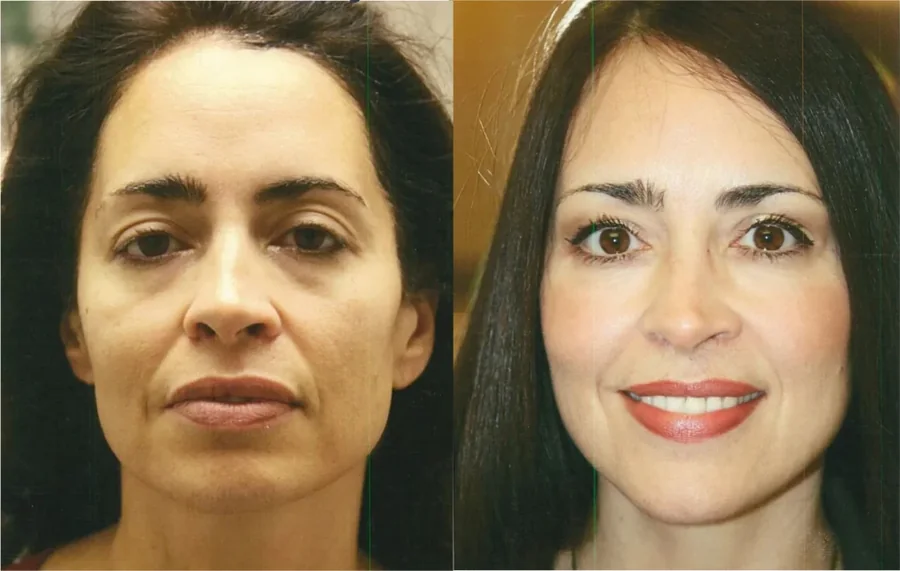 Facelift before and after