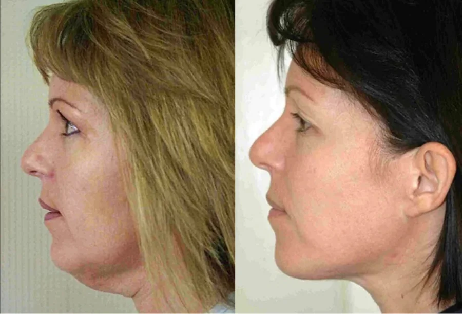 Facelift before and after