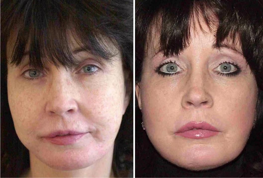 Facelift before and after