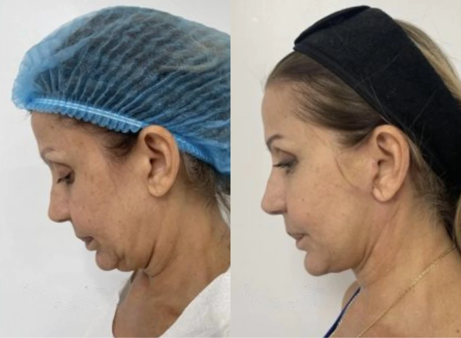 Facelift before and after
