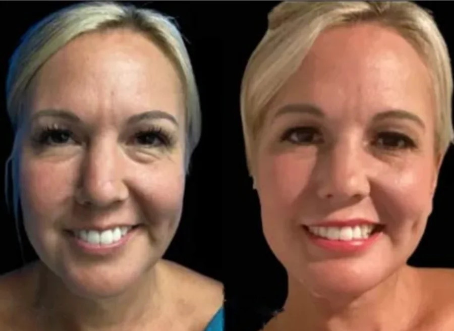 Facelift before and after