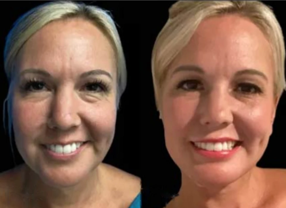 Facelift before and after