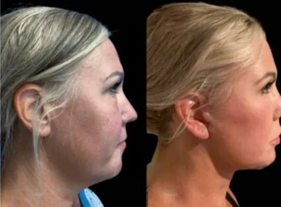 Facelift before and after