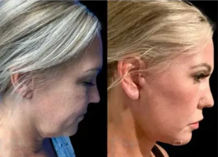 Facelift before and after
