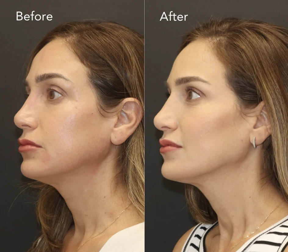 Facial balancing before and after, chin and jawline, side profile, patient 1, enlarged
