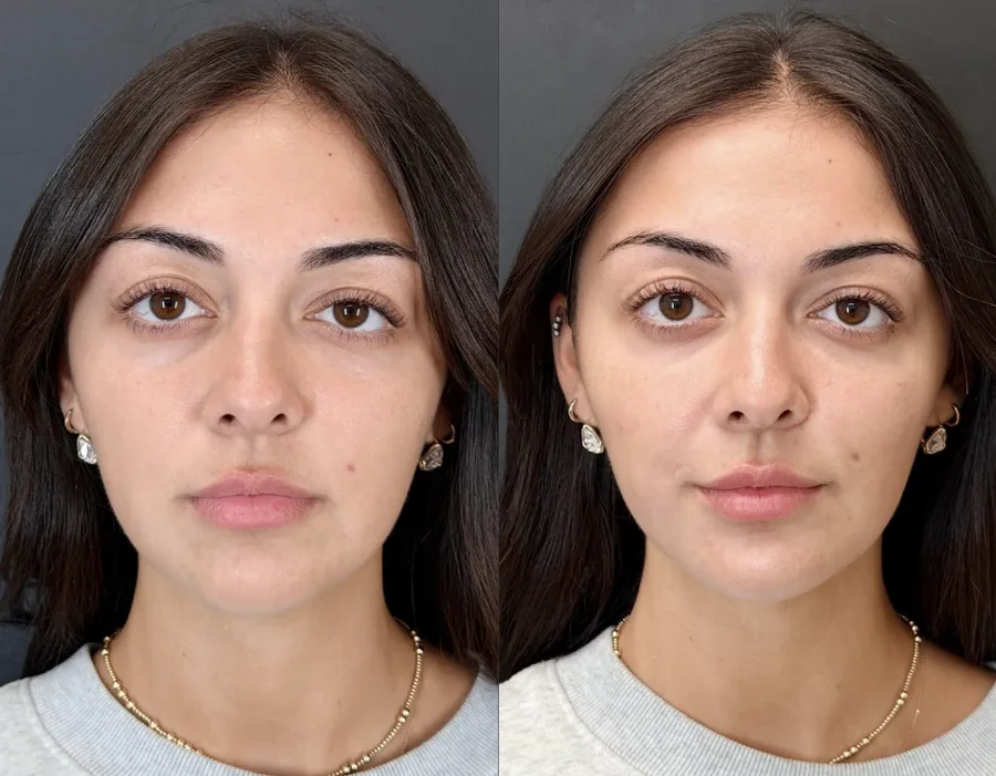 Facial balancing before and after, full face, front view, patient 2