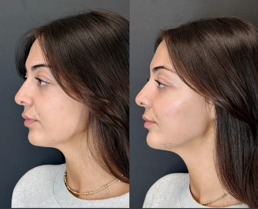 Facial balancing before and after, nose, lips and chin, left side profile, patient 2