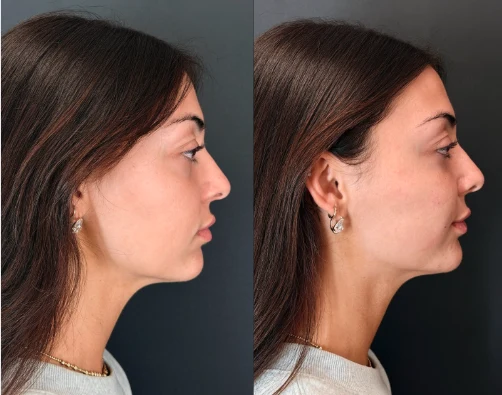 Facial balancing before and after, chin and jawline, right side profile, patient 2