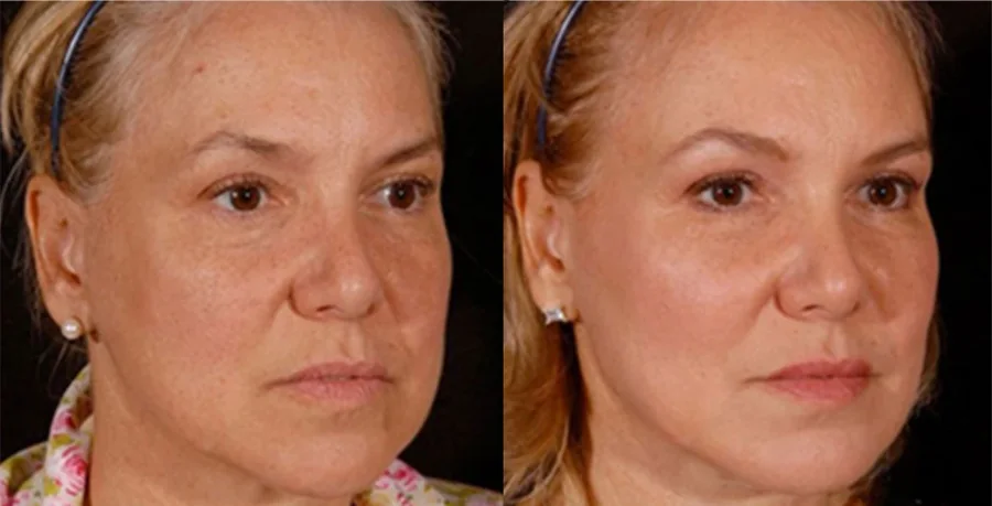 Facial Fat Grafting before and after