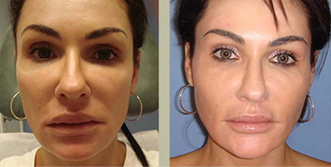 Facial Fat Grafting before and after