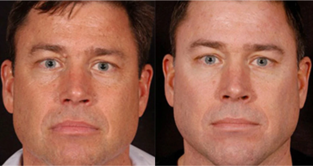 Facial Fat Grafting before and after
