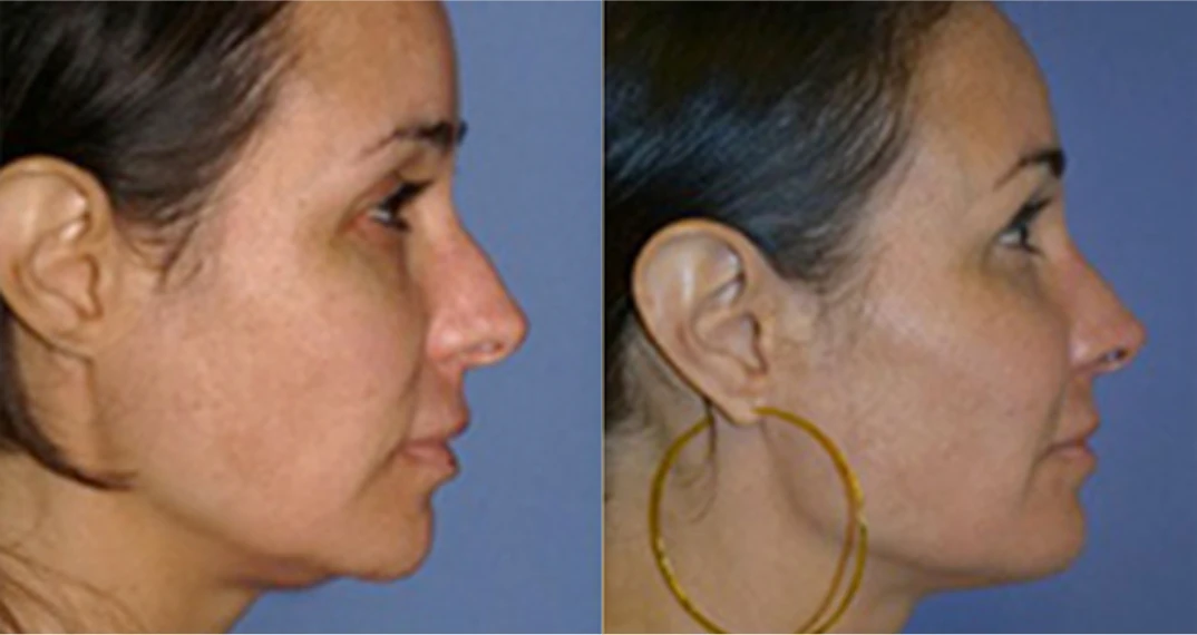 Facial Fat Grafting before and after