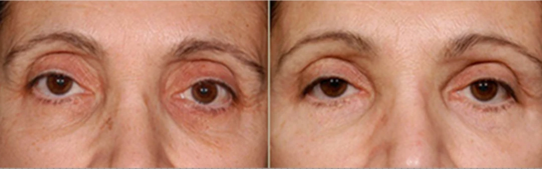 Facial Fat Grafting before and after