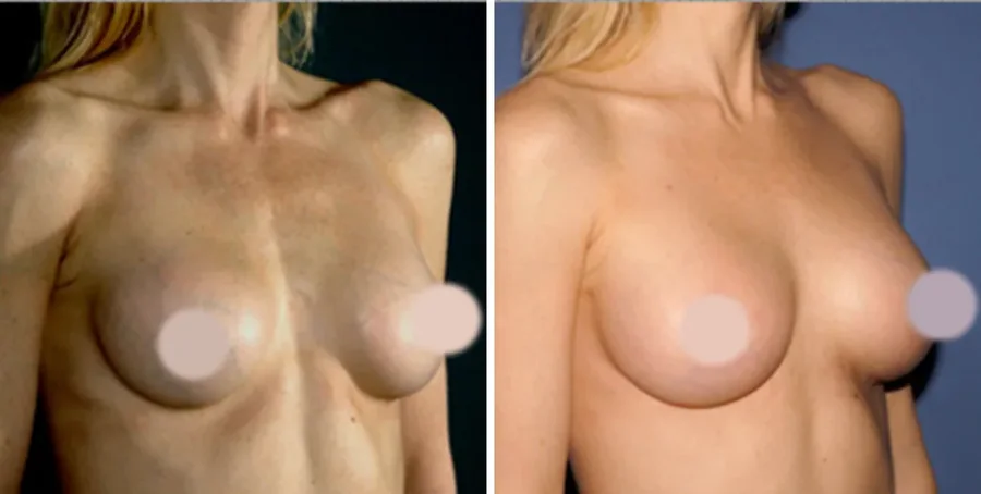 Fat Transfer to Breast before and after, oblique view