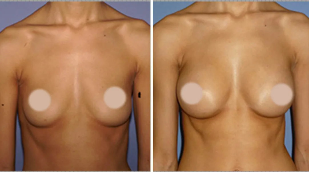 Fat Transfer to Breast before and after, front view