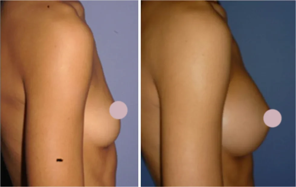 Fat Transfer to Breast before and after, side view