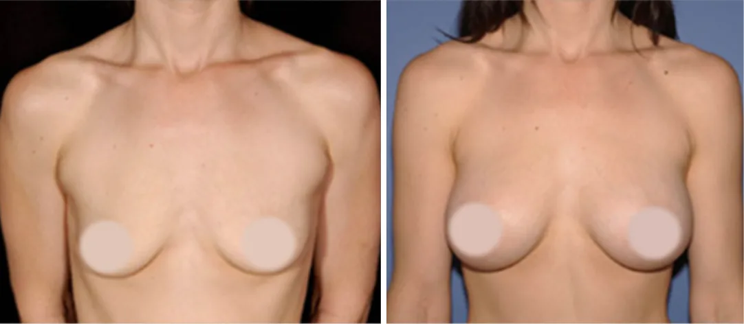 Fat Transfer to Breast before and after, front view