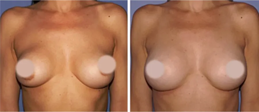 Fat Transfer to Breast before and after, front view