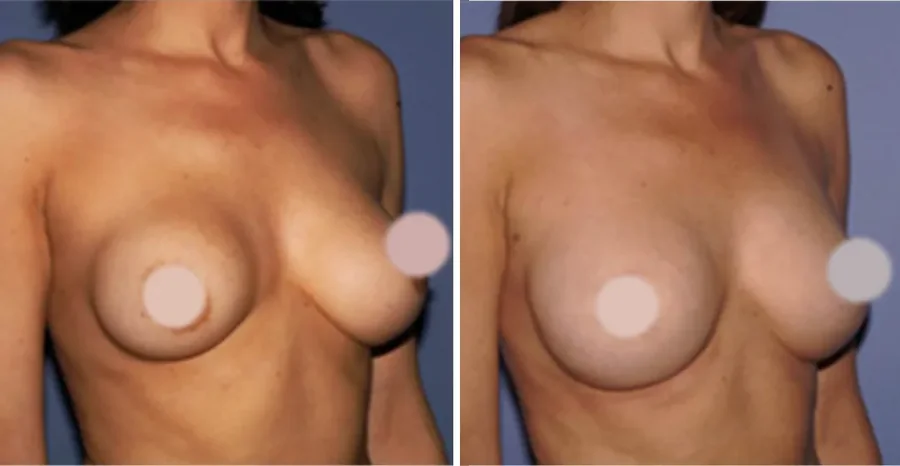 Fat Transfer to Breast before and after, oblique view