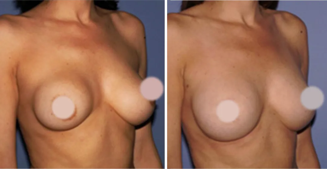 Fat Transfer to Breast before and after, oblique view