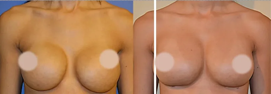 Fat Transfer to Breast before and after, front view