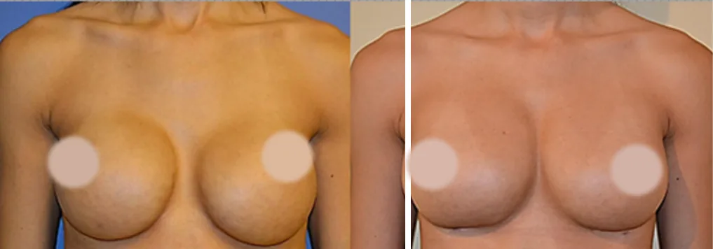 Fat Transfer to Breast before and after, front view