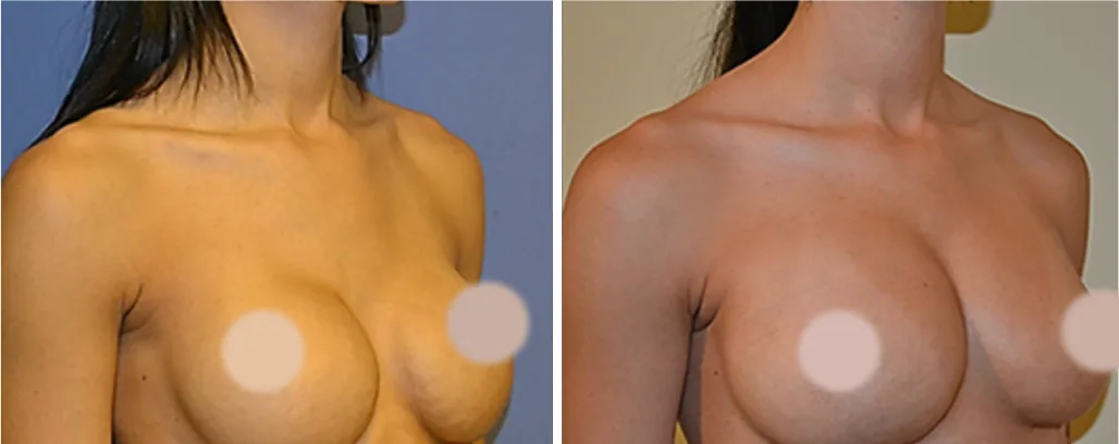 Fat Transfer to Breast before and after, oblique view