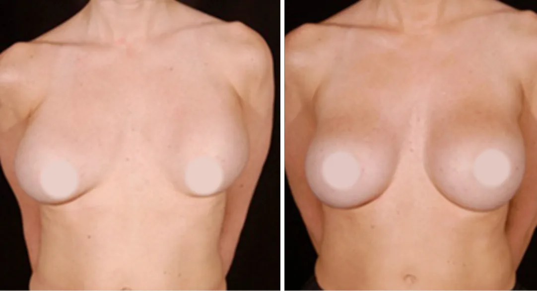 Fat Transfer to Breast before and after, front view