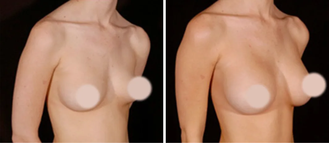 Fat Transfer to Breast before and after, oblique view