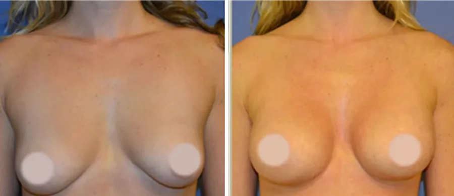Fat Transfer to Breast before and after, front view