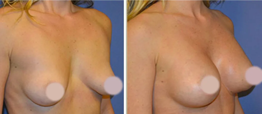 Fat Transfer to Breast before and after, oblique view