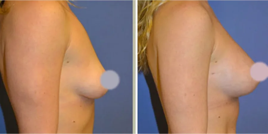 Fat Transfer to Breast before and after, side view