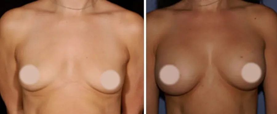 Fat Transfer to Breast before and after, front view