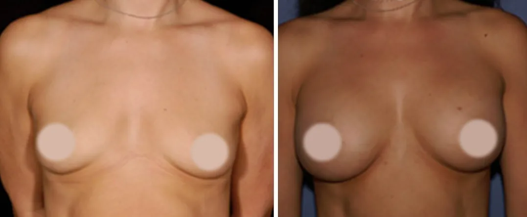Fat Transfer to Breast before and after, front view
