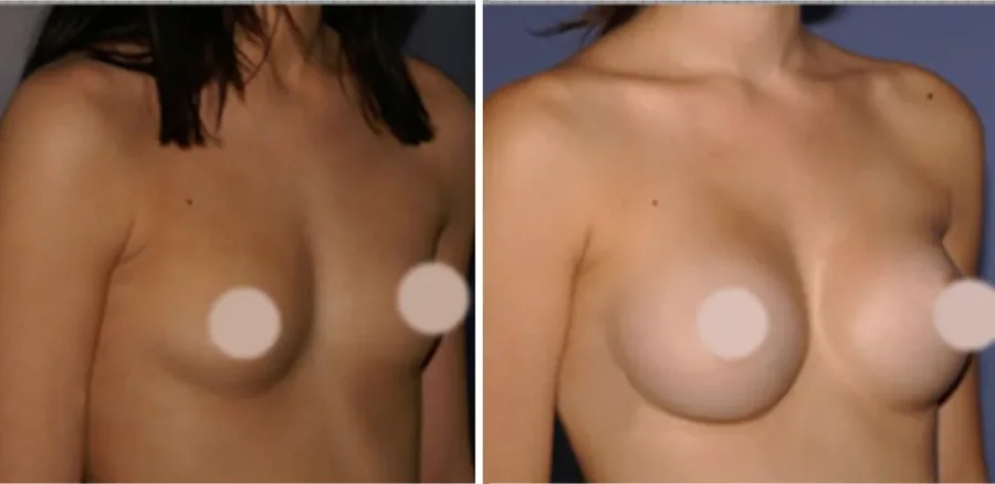 Fat Transfer to Breast before and after, oblique view