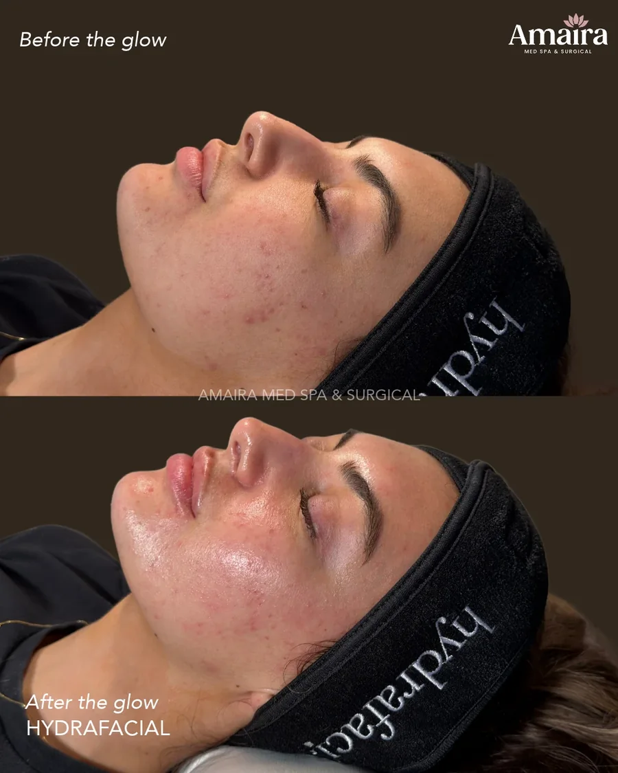 HydraFacial before and after results, clearer glowing skin, patient 1