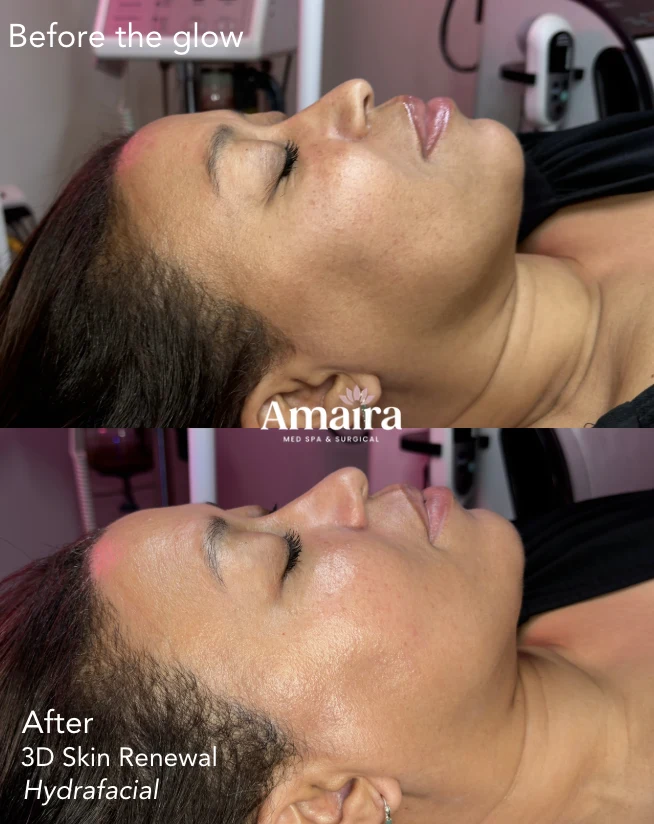 HydraFacial before and after, skin glow and texture, cheek close-up, patient 2