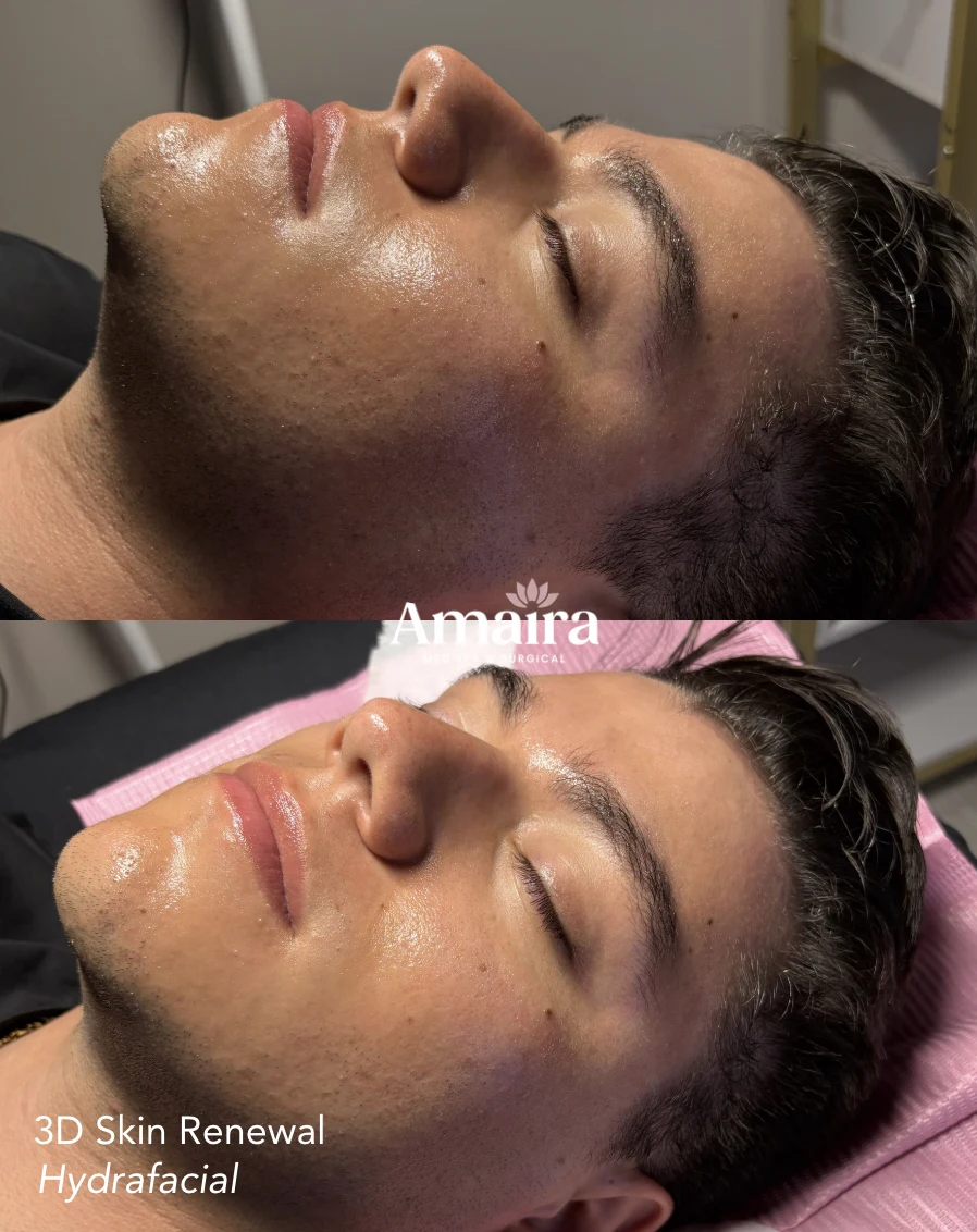 HydraFacial before and after, men's skin clarity, side view, patient 4