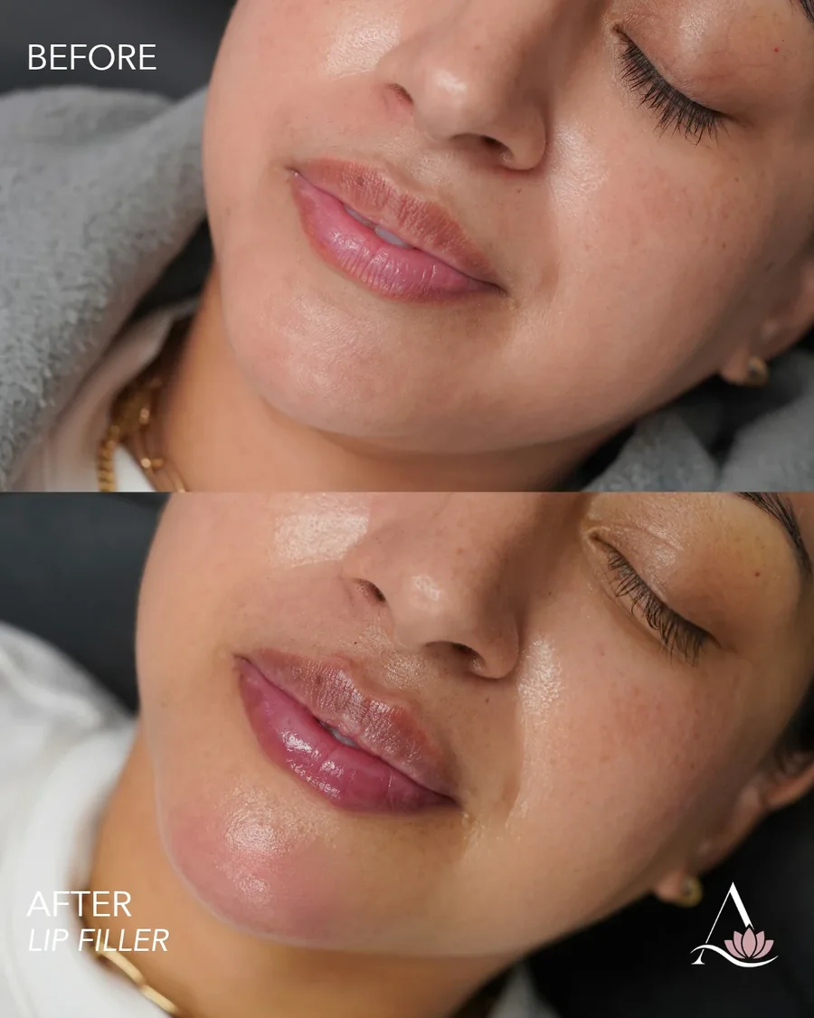 Lip filler before and after results, fuller defined lips, three-quarter view, patient 1