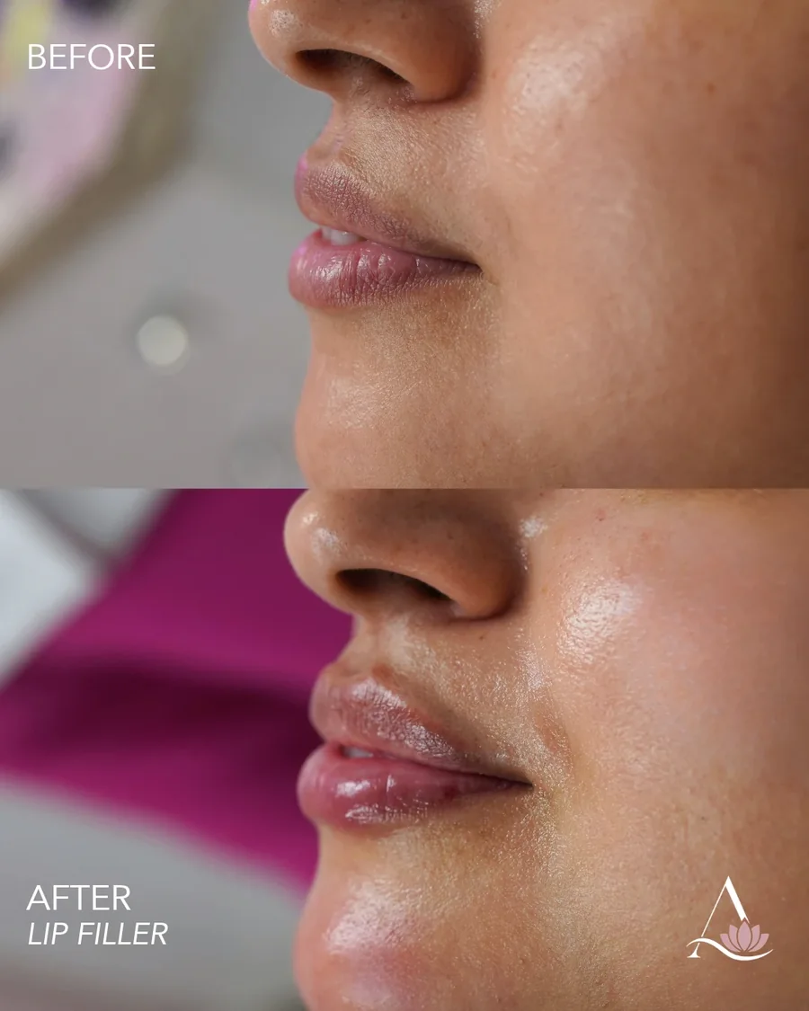 Lip filler before and after results, lip volume and shape, side profile, patient 2