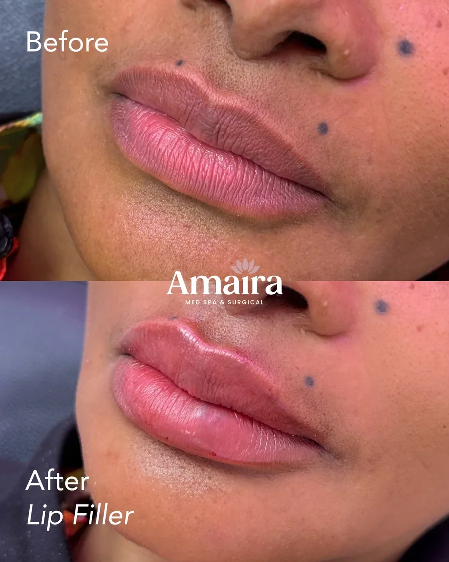 Lip filler before and after, fuller lips and defined border, close-up, patient 3