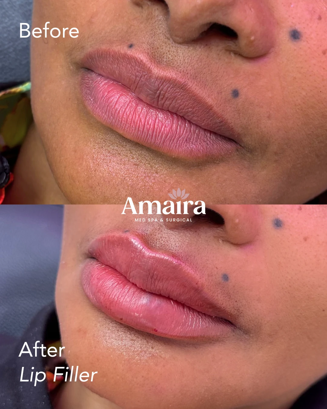 Lip filler before and after, fuller lips and defined border, close-up, patient 3, enlarged