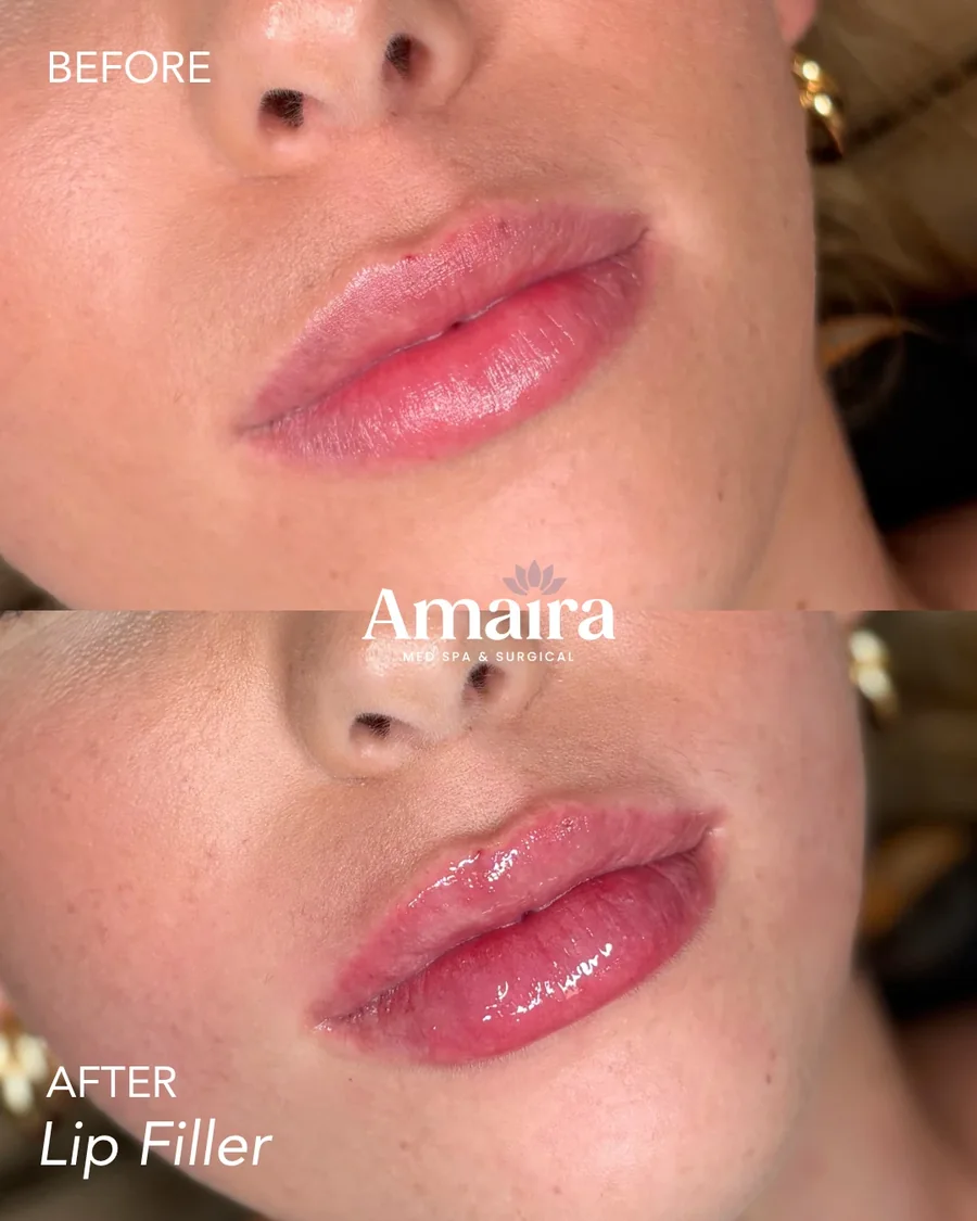 Lip filler before and after, plumper lips, close-up, patient 4