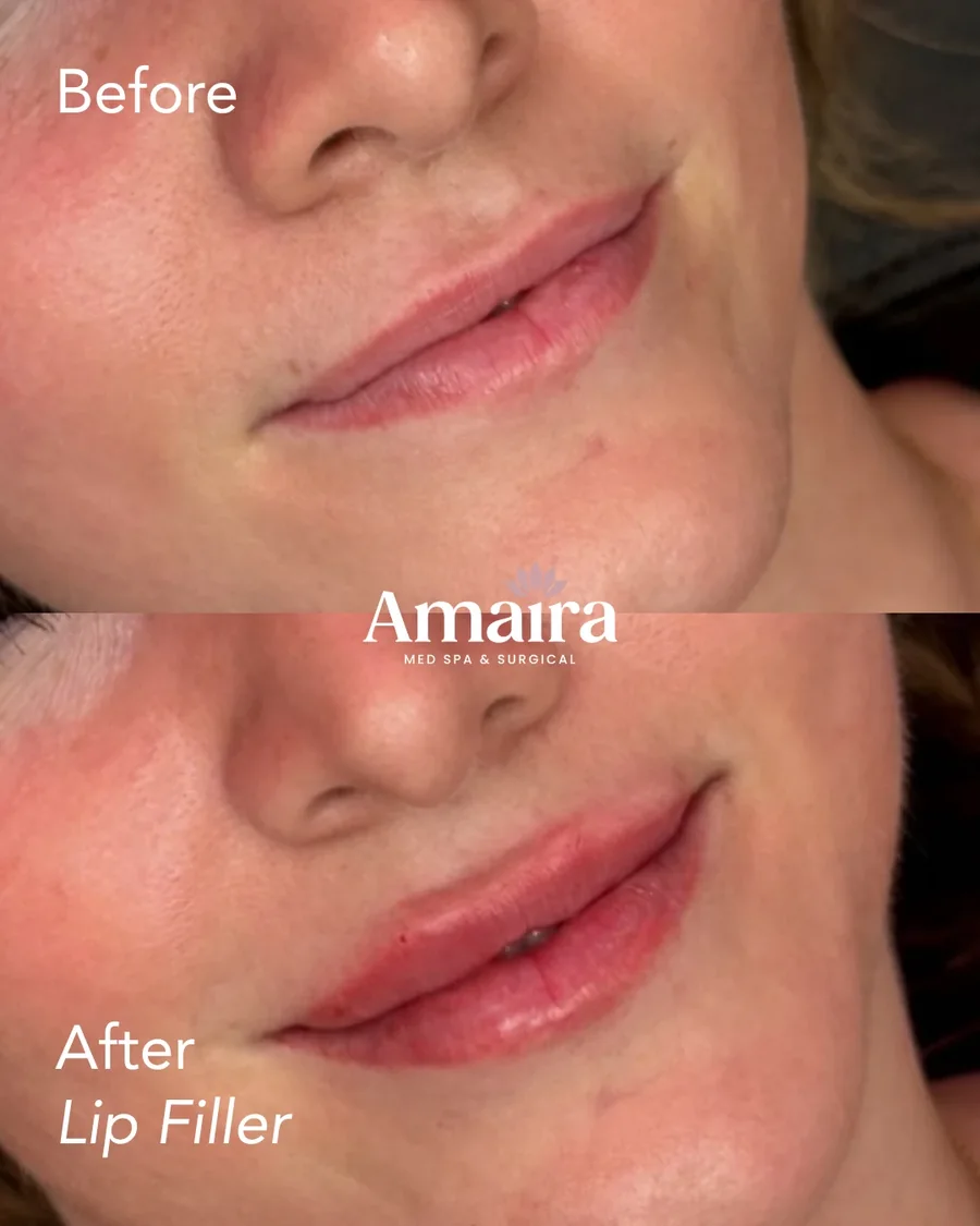 Lip filler before and after, lip volume, three-quarter close-up, patient 5