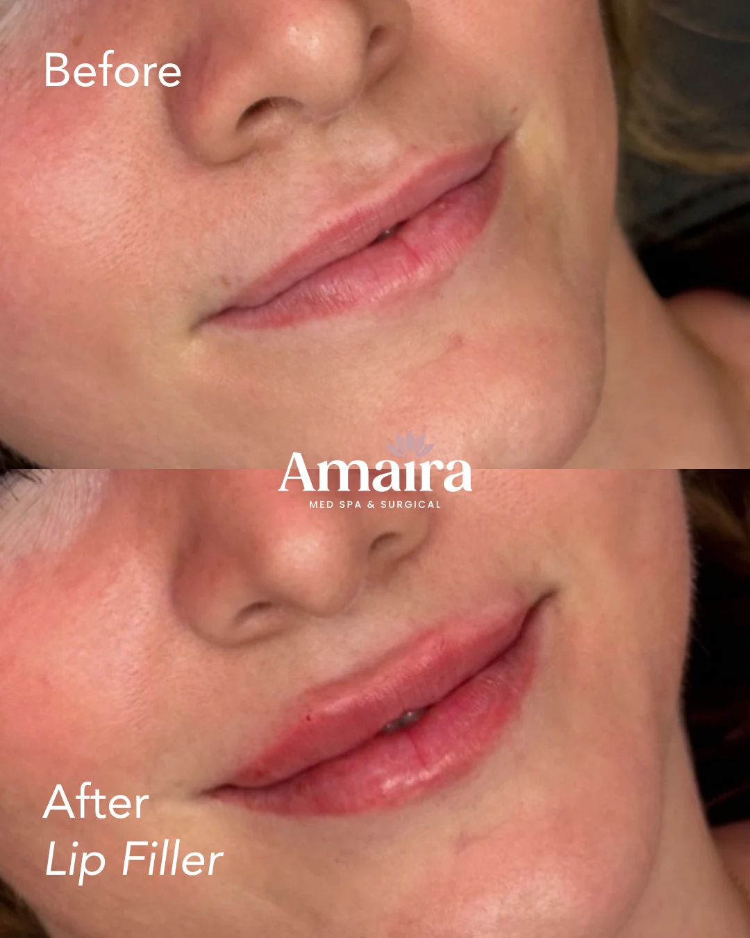 Lip filler before and after, lip volume, three-quarter close-up, patient 5, enlarged