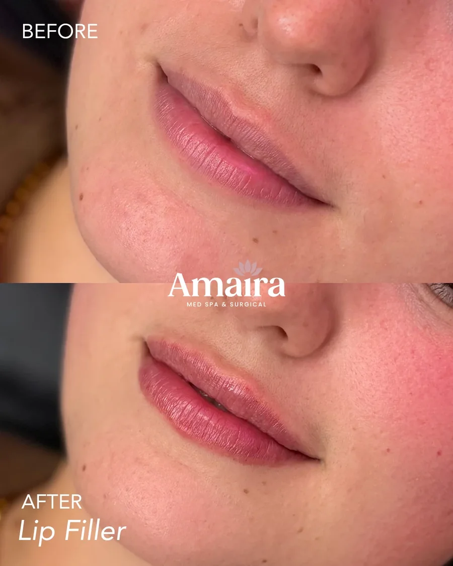 Lip filler before and after, natural lip enhancement, three-quarter close-up, patient 6