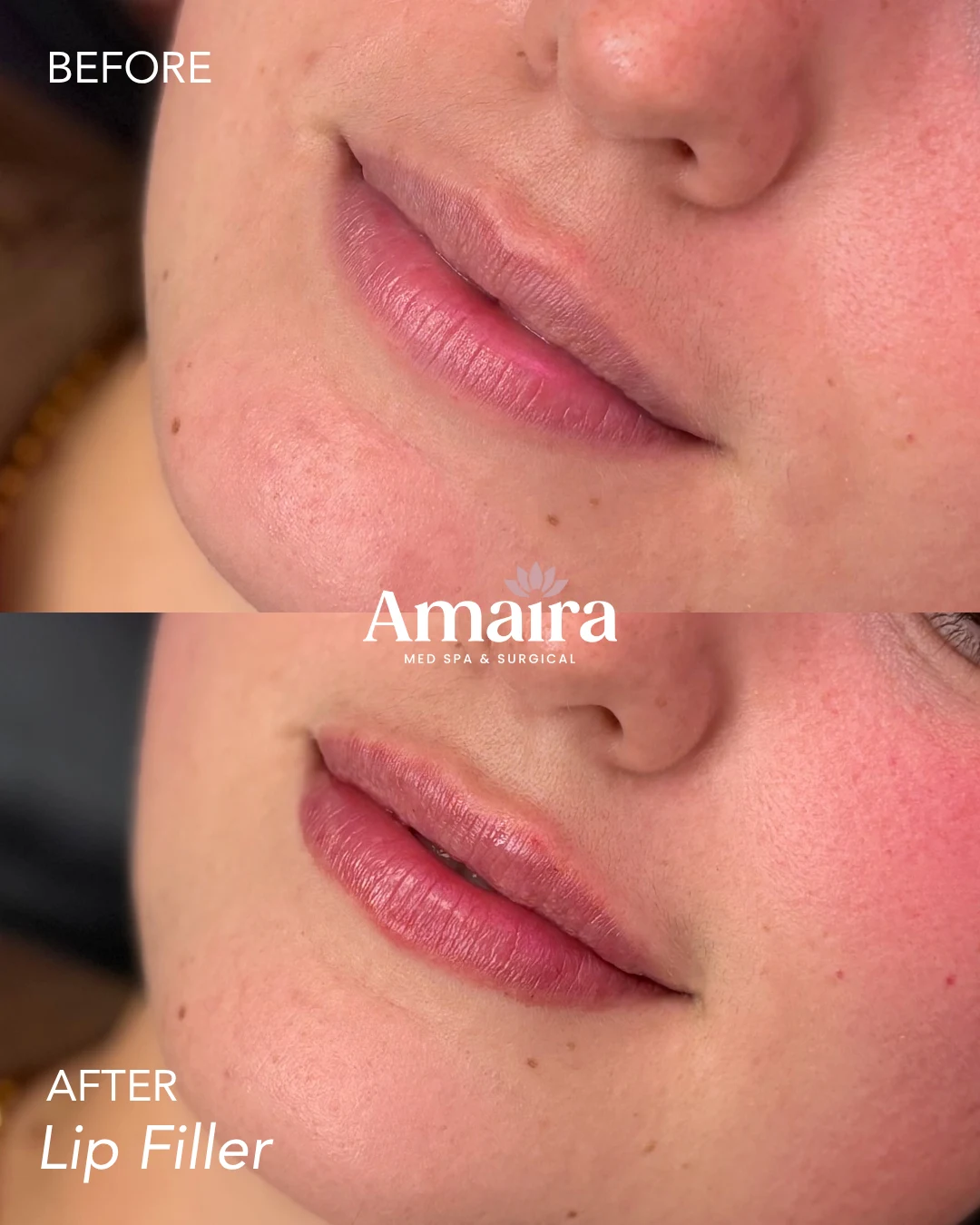 Lip filler before and after, natural lip enhancement, three-quarter close-up, patient 6, enlarged